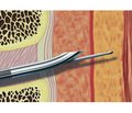 Опыт применения различных методик проведения комбинированной спинально-эпидуральной анестезии при реконструктивных операциях на артериях нижних конечностей