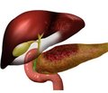Surgical treatment of patients with compressive complications of chronic pancreatitis