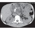 A case of successful radical surgical treatment of chronic pancreatitis complicated by a giant pseudoaneurysm of the common hepatic artery