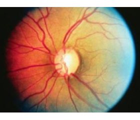 Зв’язок поліморфізму rs35934224 гена TXNRD2 з первинною відкритокутовою глаукомою
