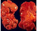 Особливості стану імунної системи  в потенційних реципієнтів  ниркового трансплантата дитячого віку