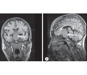 Нейроофтальмологічні аспекти великих і гігантських аденом гіпофіза