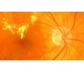 Порушення агрегації тромбоцитів як чинник розвитку діабетичної макулопатії та діабетичного макулярного набряку у хворих на непроліферативну діабетичну ретинопатію при цукровому діабеті 2-го типу
