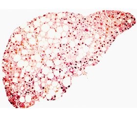Changes in the brain vessels in patients with non-alcoholic fatty liver disease and carbohydrate metabolism disorder