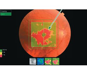 Эффективность глазных капель Травинор® и Дорзитим® в лечении первичной открытоугольной глаукомы и некоторые биоморфометрические корреляции