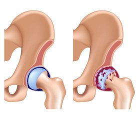 Роль параметрів остеосцинтиграфії в діагностиці імплант-асоційованих параендопротезних ускладнень при ендопротезуванні кульшових  та колінних суглобів