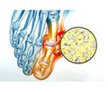 Гострий подагричний артрит і швидкопрогресуюча ниркова недостатність як маніфестація множинної мієломи: опис клінічного випадку