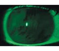 Фіксована комбінація гіалуронової кислоти й декспантенолу в покращенні стану передньої поверхні ока після хірургії катаракти