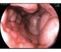 Portal hypertension complicated by bleeding from esophageal and gastric varices:  the present state of the problem of treatment and prevention
