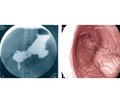 Complications of gastric plication. Methods of prevention and correction methods