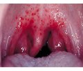 The features of clinical manifestations of mixed infectious mononucleosis in a 3-year-old child