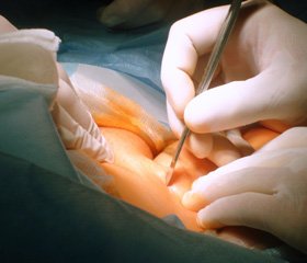 Кількісна оцінка результатів радикального хірургічного лікування гострого варикотромбофлебіту у басейні великої та малої підшкірних вен