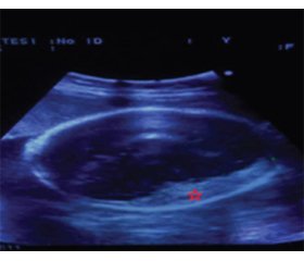 Intrauterine subdural hematoma associated with blunt maternal trauma: a case report