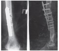 Лiкування дiафiзарних переломiв плечової кістки за допомогою блокуючого iнтрамедулярного металоостеосинтезу в умовах Обласної лікарні інтенсивного лікування м. Маріуполя