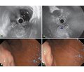 The role of endoscopic ultrasound investigation in the diagnosis of submucosal neoplasms of the stomach and duodenum (literature review and our clinical observations)