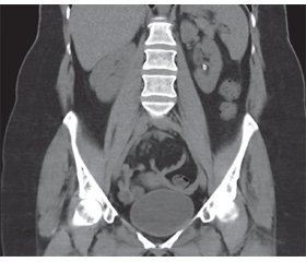 Spontaneous retrograde urolithiasis migration in a woman: a case report and possible mechanism