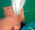 Комбинированная проводниковая анестезия при оперативных вмешательствах на щитовидной железе