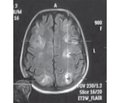 Posterior reversible encephalopathy syndrome in obstetrics