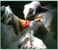 Місцеве лікування ішемічних ранових дефектів нижніх кінцівок із використанням модифікованих біологічних середовищ