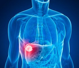 Increasing Efficacy of Treatment in Patients with Steatohepatitis