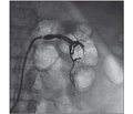 Нефропротекция при остром повреждении почек, вызванном тромбозом почечной артерии