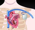 Ученые, используя специальный вирус, успешно восстановили естественный «кардиостимулятор» сердца