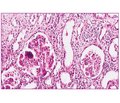 HIV-Associated Nephropathy: Clinical and Morphological Features (Own Observations)