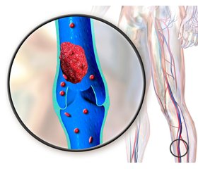 Профілактика венозного тромбоемболізму при хірургічному лікуванні перелому стегнової кістки