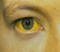 Differential diagnosis of jaundice in the prehospital phase