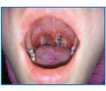 Analysis of clinical cases of membranous pharyngitis associated with Corynebacterium ulcerans