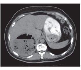 Treatment of Single Liver Abscesses: Drainage or Resection?