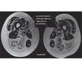 Діагностична роль магнітно-резонансної томографії м’язів при нервово-м’язових захворюваннях (науковий огляд та особисте спостереження)