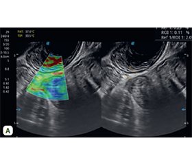 Роль трансректального ультразвукового дослідження в оцінці тяжкості та диференціальній діагностиці запальних захворювань кишечника: порівняльний аналіз при виразковому коліті та хворобі Крона