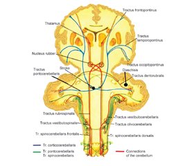 Case analysis of crossed pontine-cerebellar diaschisis in acute stroke patients