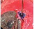 Visualization technique for juxtacanalicular tissue in non-penetrating deep sclerectomy