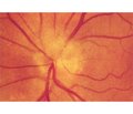 Застосування цитиколіну в офтальмологічній практиці: нейропротекція при ішемічній оптичній нейропатії, діабетичній ретинопатії та амбліопії