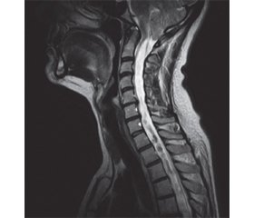 Cerebrospinal fluid flow impairment in the patients with Chiari malformation: predictors of syringomyeliа cysts development and dynamics of postoperative regression