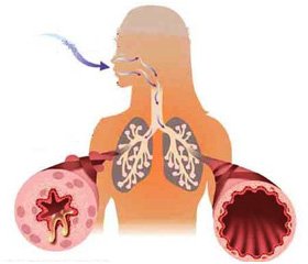 Предиктори формування бронхіальної астми в дітей шкільного віку на Тернопільщині