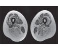 Роль магнітно-резонансної томографії м’язів у диференційній діагностиці окремих форм та підтипів кінцівково-поясної м’язової дистрофії: аналіз клінічних випадків