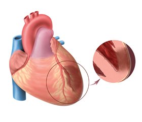 Нові можливості застосування блокатора ішемічного каскаду в терапії гострого інфаркту міокарда