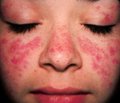 Condition of vascular wall and endothelial function in children with systemic lupus erythematosus 