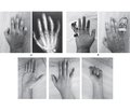 Features of conservative treatment of patients with post-traumatic stiff interphalangeal joints