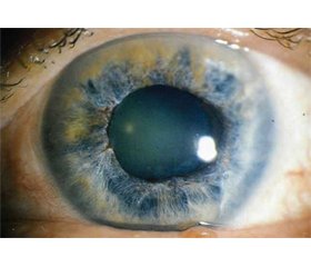 Латанопростен бунод 0,024% краплі очні (Візулта™) — нові можливості в лікуванні первинної відкритокутової глаукоми