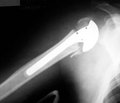 Результаты лечения больных с многофрагментарными переломами проксимального отдела плечевой кости путем применения фиксатора оригинальной конструкции