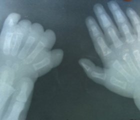 Актуальные вопросы современной диагностики и лечения стенозирующих лигаментитов пальцев кисти у детей