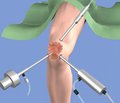 Применение декскетопрофена с целью послеоперационной аналгезии у пациентов, перенесших артроскопию коленного сустава