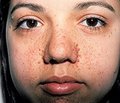 Tuberous sclerosis. Сlinical observation