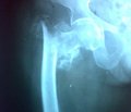 Малоинвазивный остеосинтез при переломах проксимального отдела бедренной кости у больных пожилого возраста