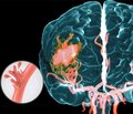 Нейровизуализационные и клинические параллели у молодых пациентов с ишемическим инсультом, обусловленным аномалиями церебральных артерий
